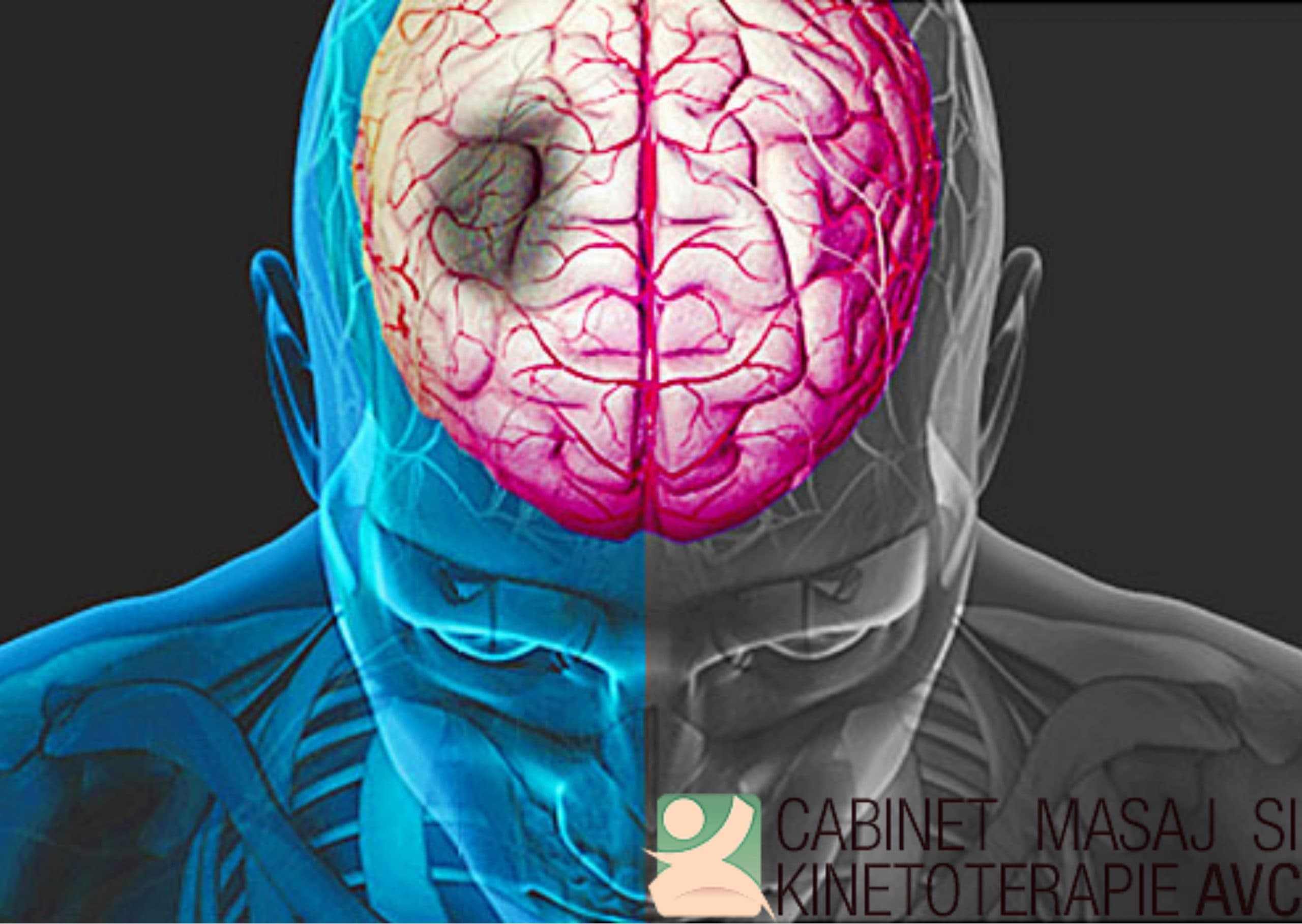 Ilustrație accident vascular cerebral — recuperare post-AVC la domiciliu