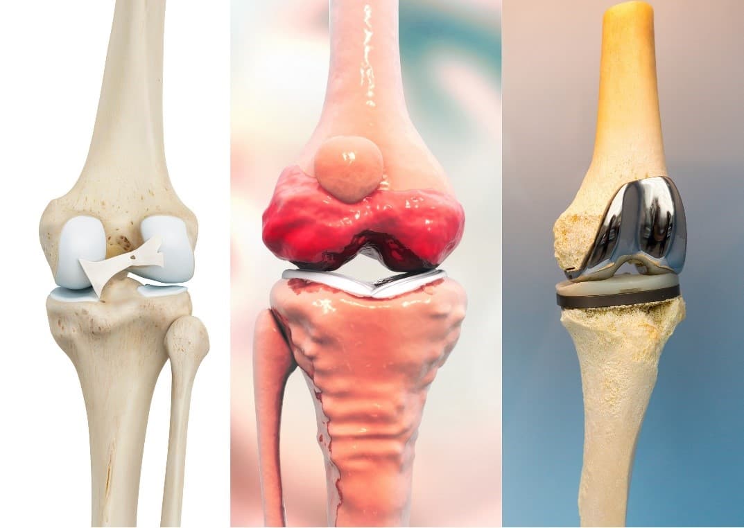 Proteză de genunchi — recuperare post-operatorie la domiciliu